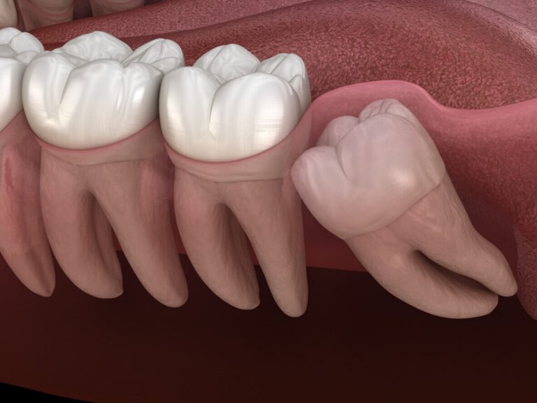 Impacted Wisdom tooth in 3d
