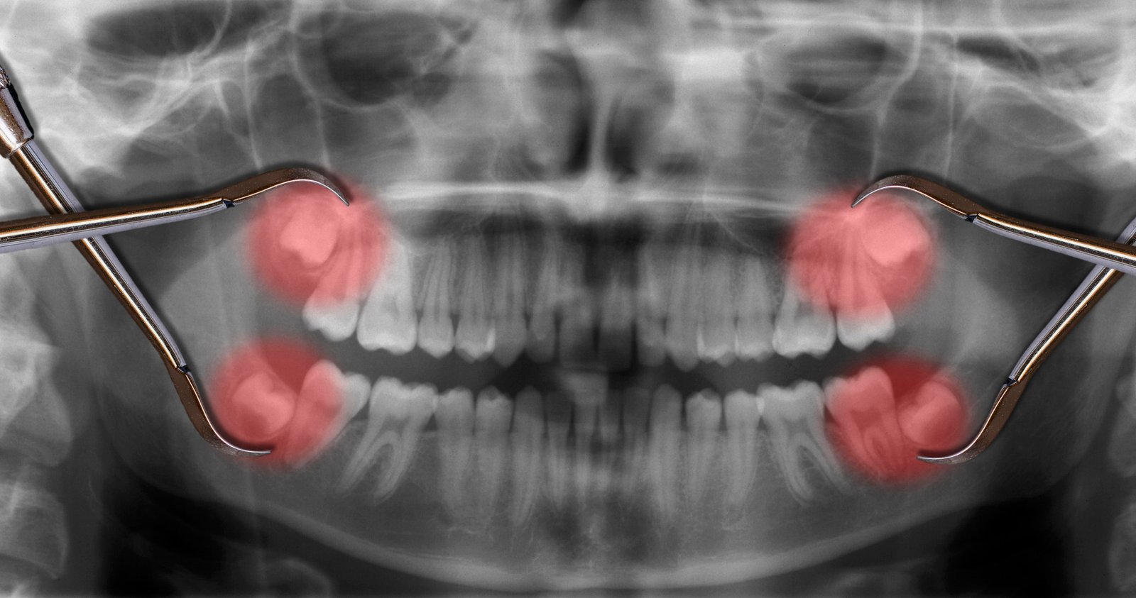 dental x-ray of mouth