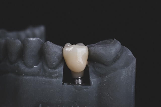 dentist showing dental implant