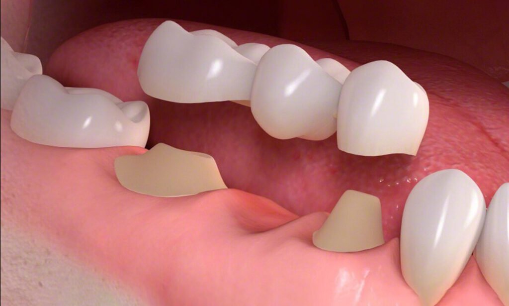 3d dental bridge in mouth