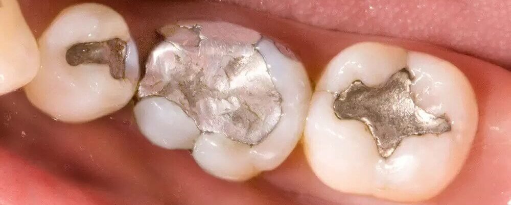 Silver fillings on teeth