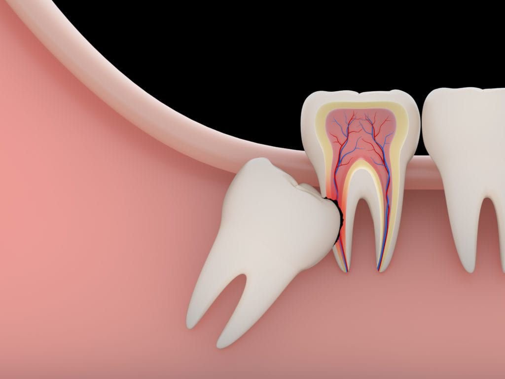 Impacted wisdom tooth graphic