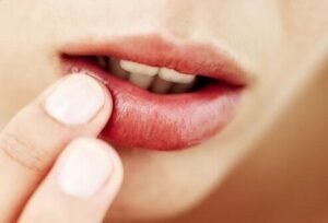 woman touching lip with cold sores