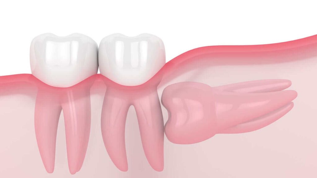 3d impacted wisdom tooth